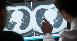 Studie: Individuelle Alterung hat Einfluss auf Krebsrisiko