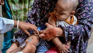 Bangladesch verzeichnet mehr als 220 Todesfälle durch Masern seit März