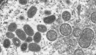 Mpox-Viren im Gepäck: Ermittlungsverfahren gegen zwei Virologen von US-Institut