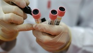 Karlsruhe billigt Blutentnahmeverbot für Heilpraktiker bei bestimmten Eigenbluttherapien