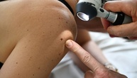Krankenkasse: Deutlicher Anstieg bei Hautkrebspatienten