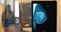 Mammografie: Altersgrenze für Brustkrebs-Früherkennung wird herabgesetzt